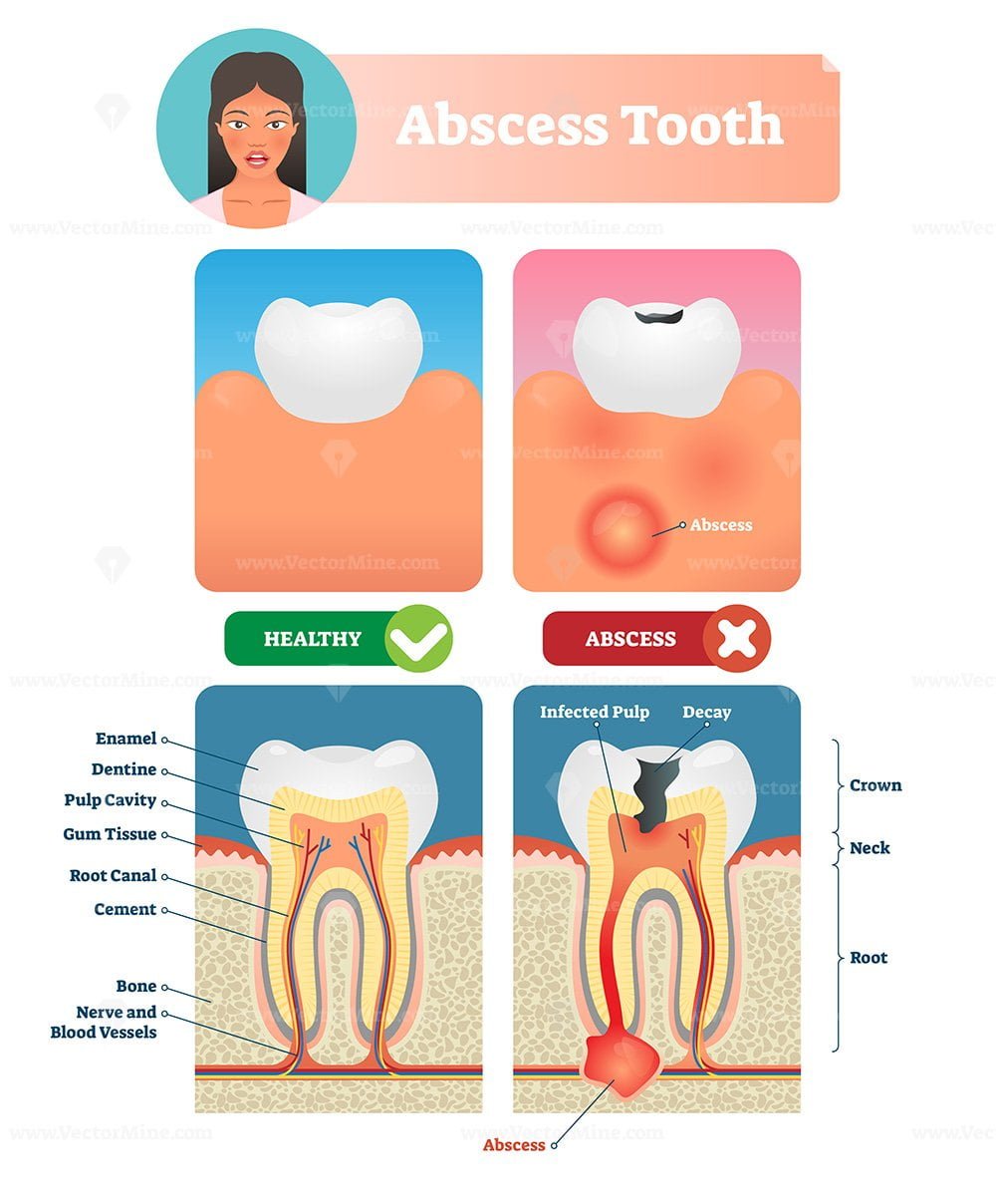 Абсцесс обозначение стоматология