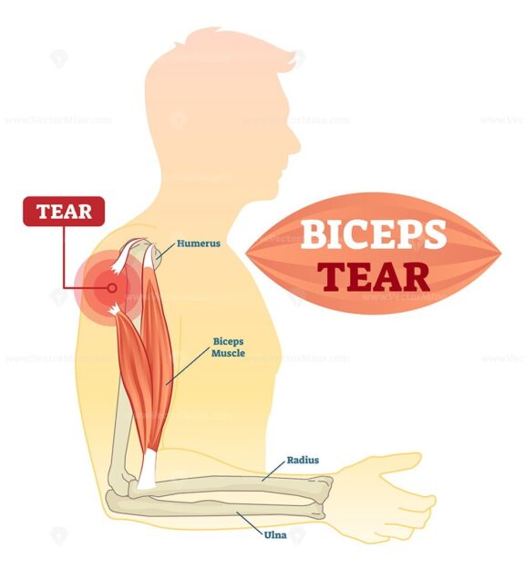 Biceps tear vector illustration