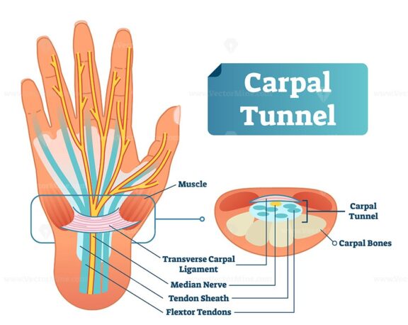Carpal tunnel vector illustration scheme