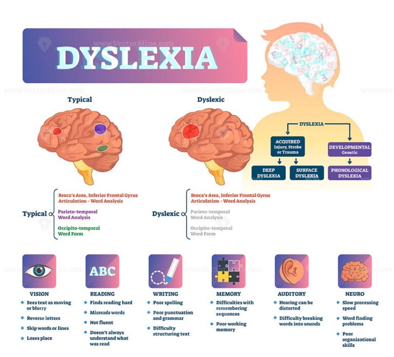 Dyslexia vector illustration