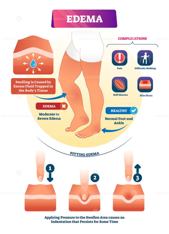 Edema vector illustration