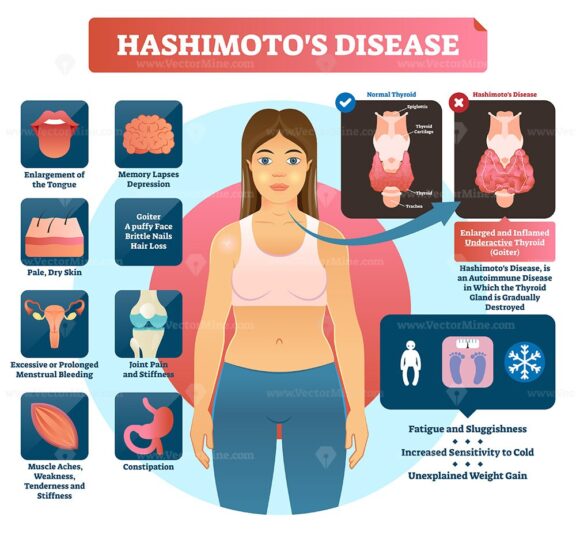 Hashimotos thyroiditis vector illustration