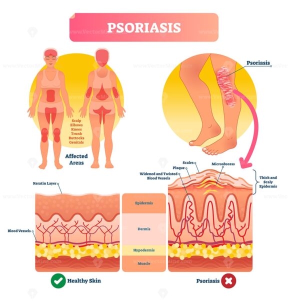 Psoriasis vector illustration