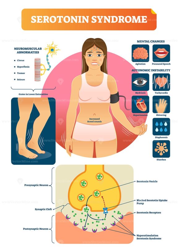 Serotonin syndrome vector illustration with medical labeled symptoms scheme