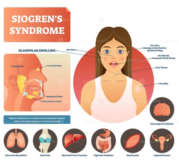 Sjogrens syndrome vector illustration