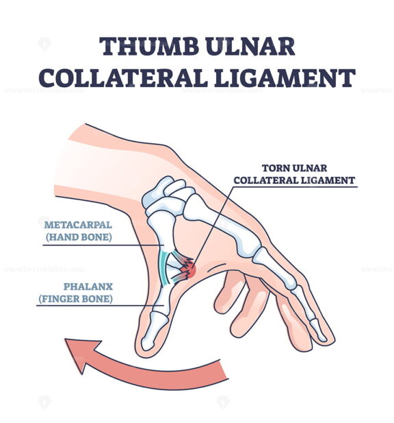 Thumb ulnar collateral ligament as finger injury and problem outline diagram