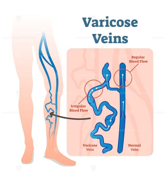 Varicose veins with irregular blood flow