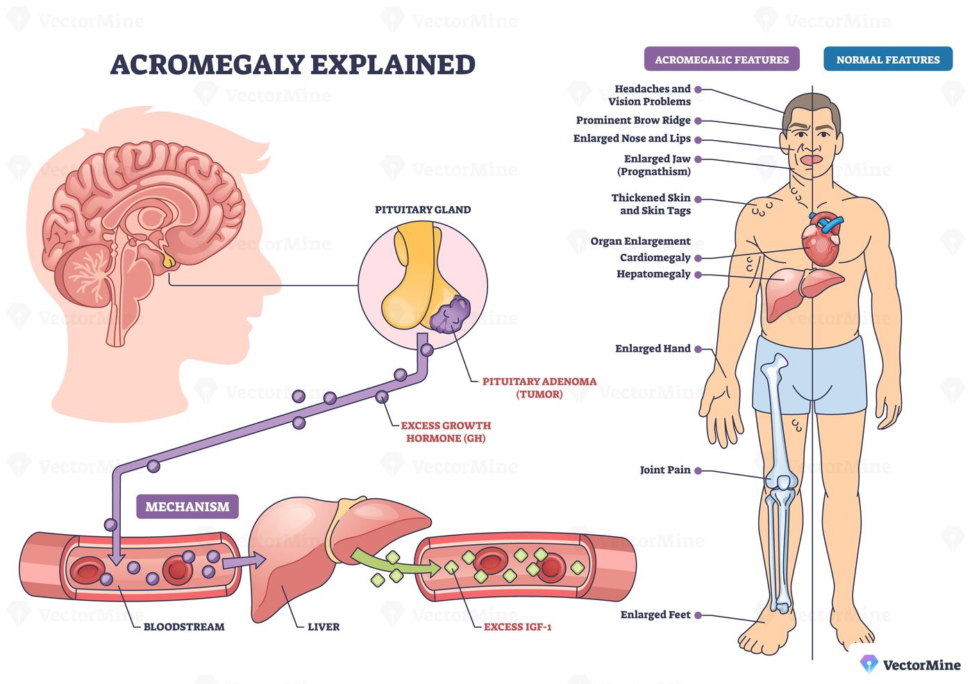 Acromegaly explained diagram visualizes pituitary tumor driving excess GH and IGF 1, affecting body growth, key objects, pituitary gland, human figure, liver. Outline diagram