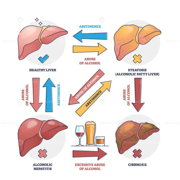 Alcoholic liver disease from excessive abuse of alcohol outline diagram
