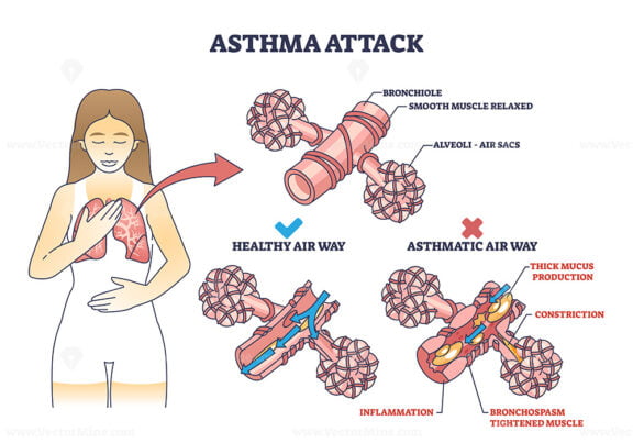 Asthma attack explanation compared with healthy air way outline diagram
