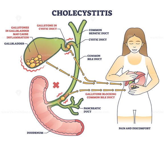 Cholecystitis as gallbladder inflammation from gallbladder outline diagram