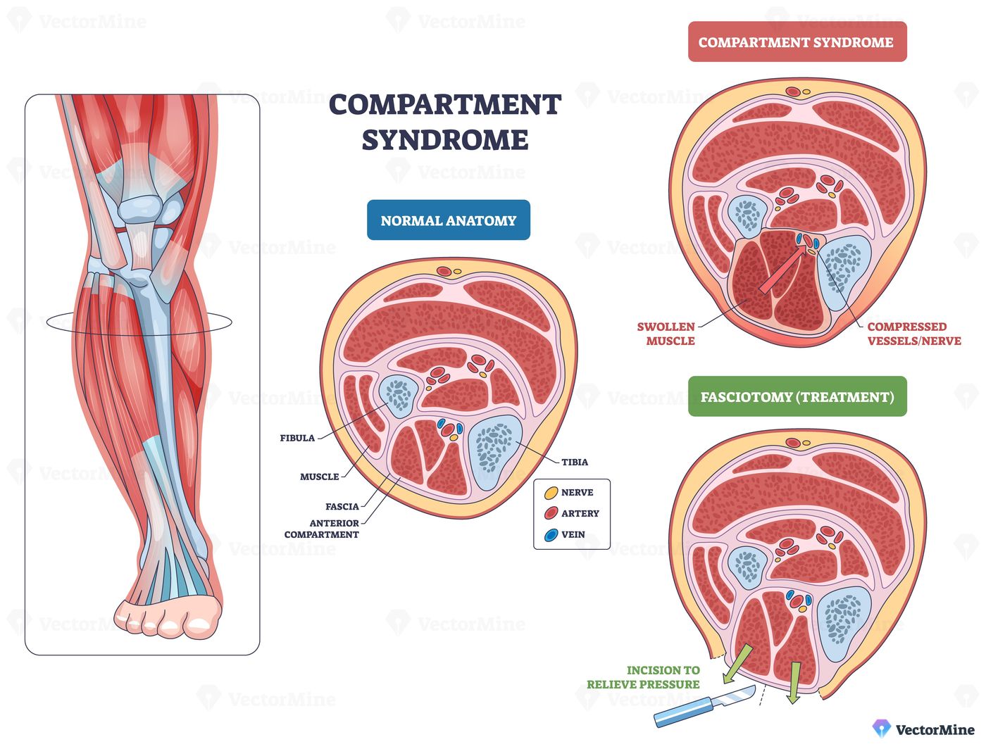 Compartment syndrome brief anatomy illustrates a leg cross-section with normal vs swollen muscle and fasciotomy relief, focusing on muscles, nerves, and vessels. Outline diagram