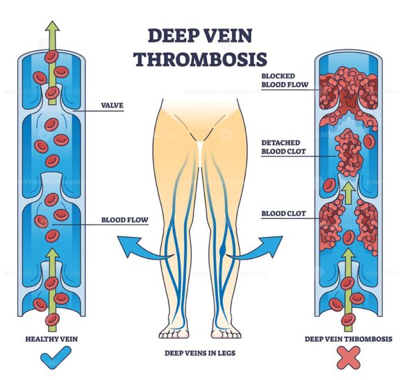 Deep vein thrombosis condition with blood clot blockage outline diagram