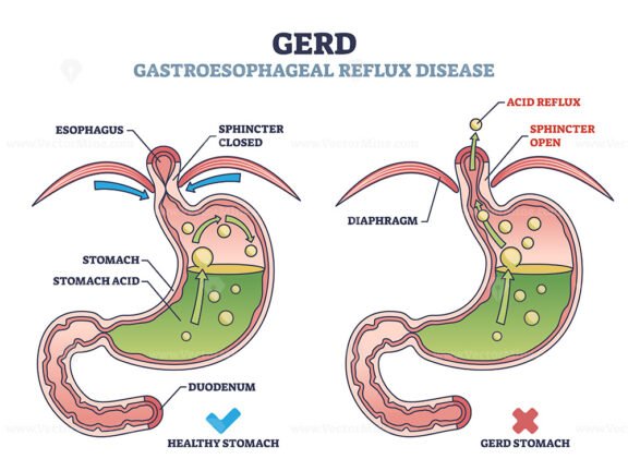 GERD or gastroesophageal reflux disease with digestive acid outline diagram