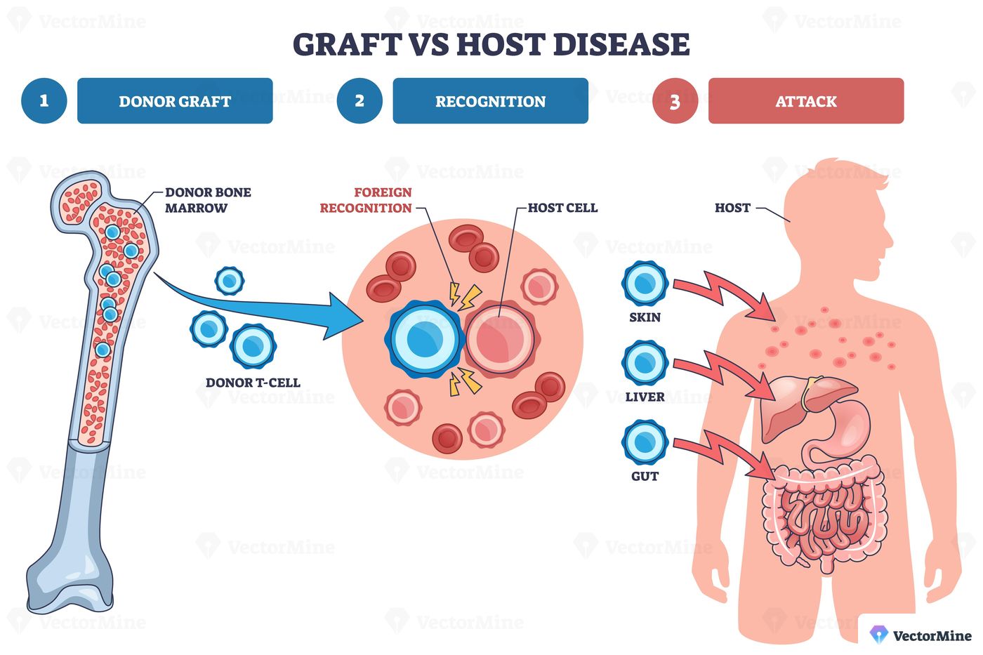 Graft vs host disease concept shows donor bone marrow and T cells recognize a host cell, then attack skin, liver, and gut in staged steps. Outline diagram