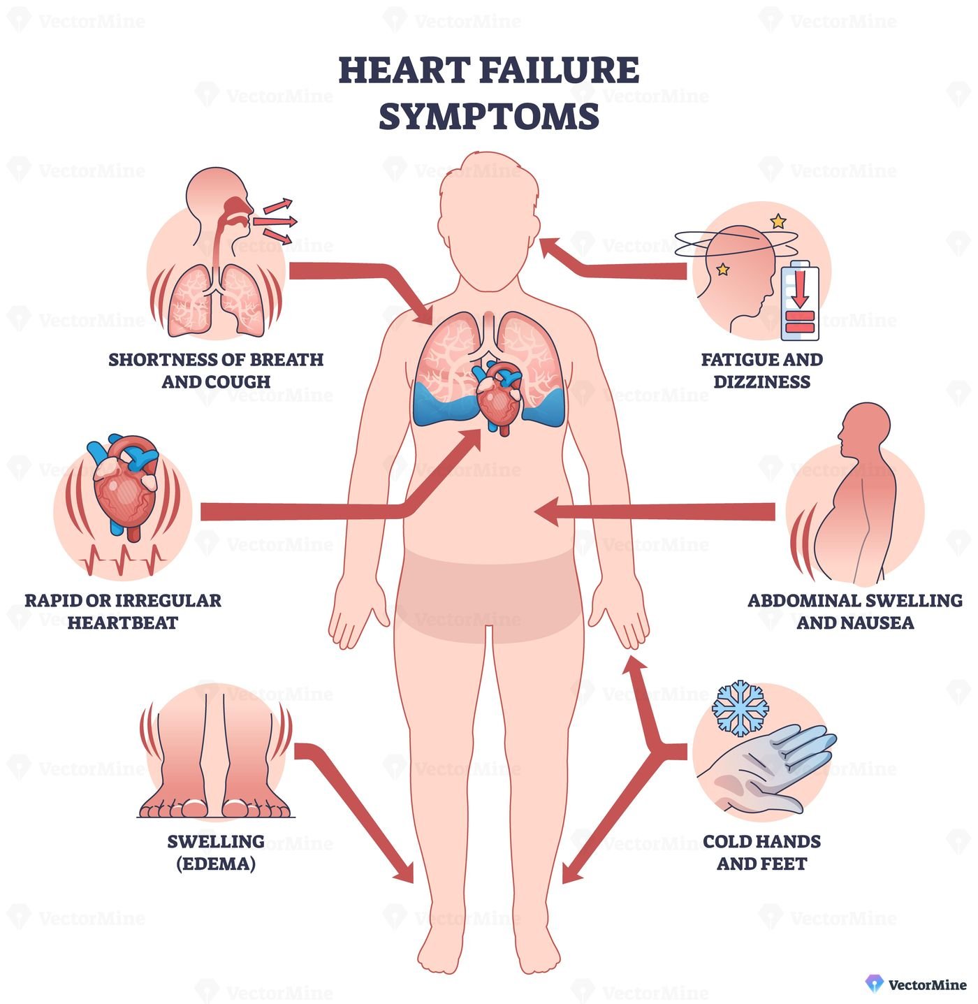 Heart failure symptoms overview shows a human silhouette with heart and lungs, arrows highlighting breathlessness, edema, and fatigue for quick patient education. Outline diagram