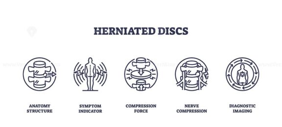Herniated discs are illustrated with outline icons showing anatomy ...