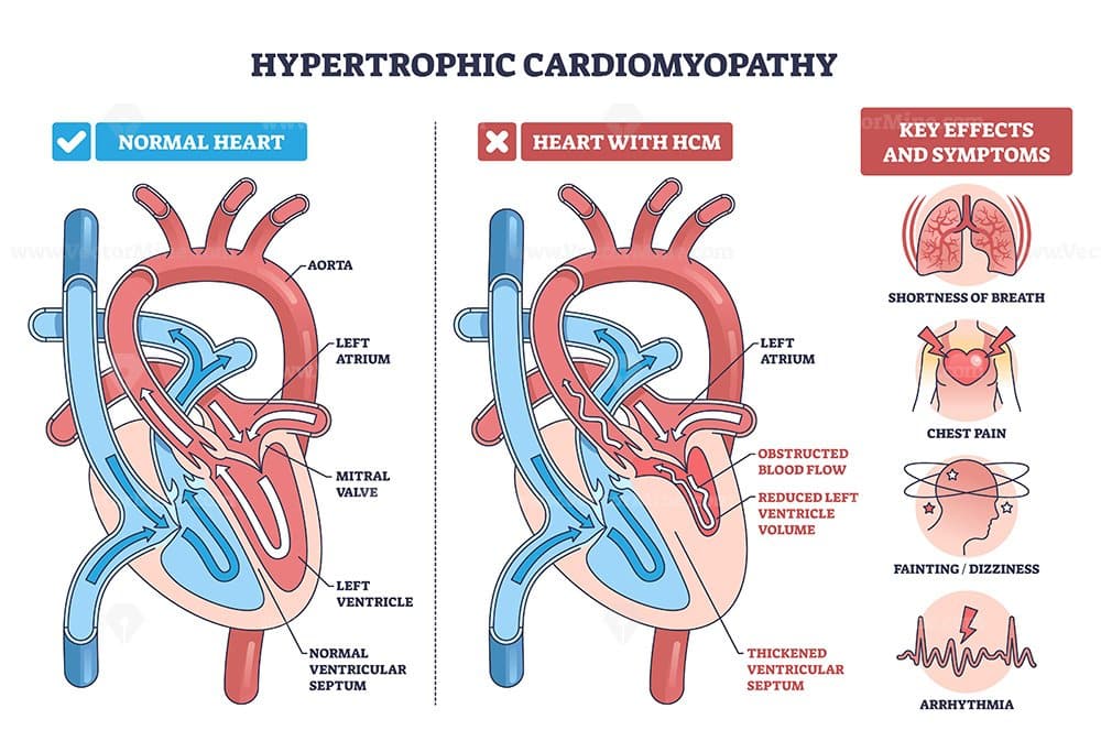 Hypertrophic cardiomyopathy diagram compares normal and HCM hearts, showing thickened septum, mitral valve obstruction, and reduced blood flow, key symptoms shown. Outline diagram