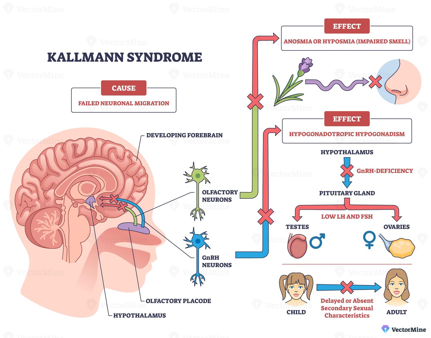 Kallmann syndrome outline shows failed neuronal migration causing anosmia and hypogonadotropic hypogonadism, key objects, brain cross-section, olfactory neurons, pituitary hormones. Outline diagram