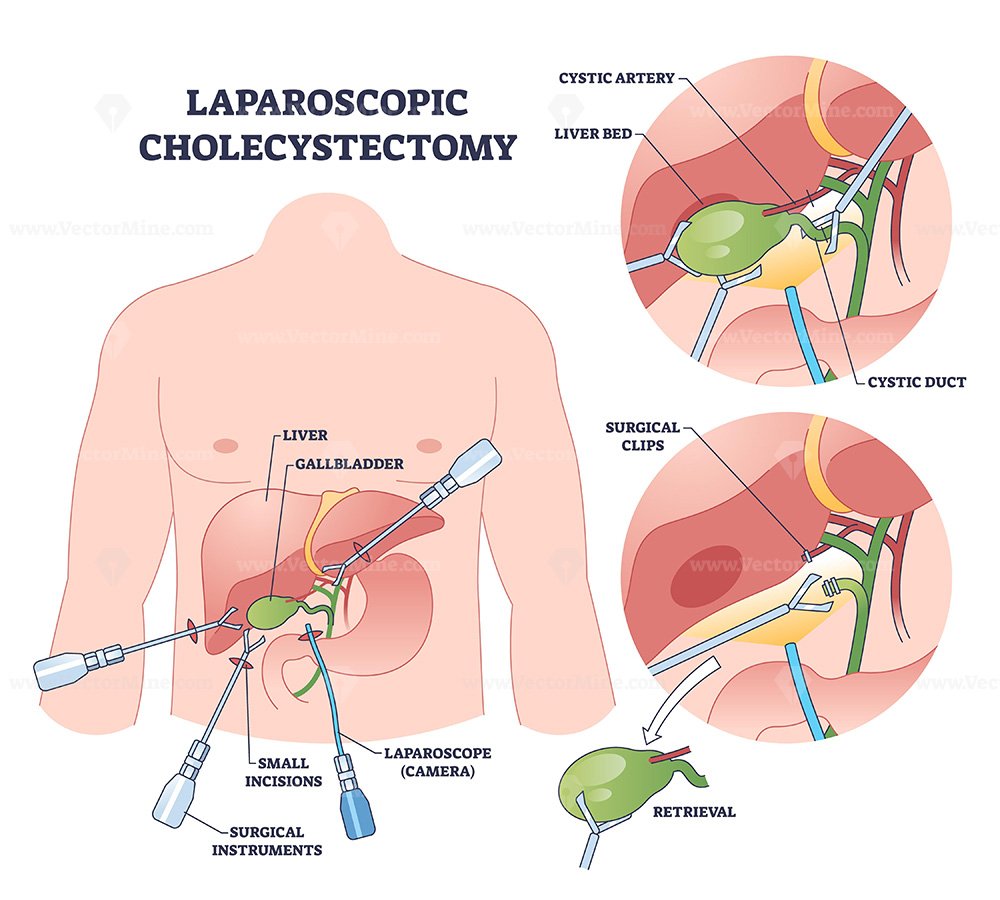 Laparoscopic cholecystectomy explained, instruments insert through small incisions to clip cystic duct and remove the gallbladder, highlights laparoscope, gallbladder, surgical clips. Outline diagram