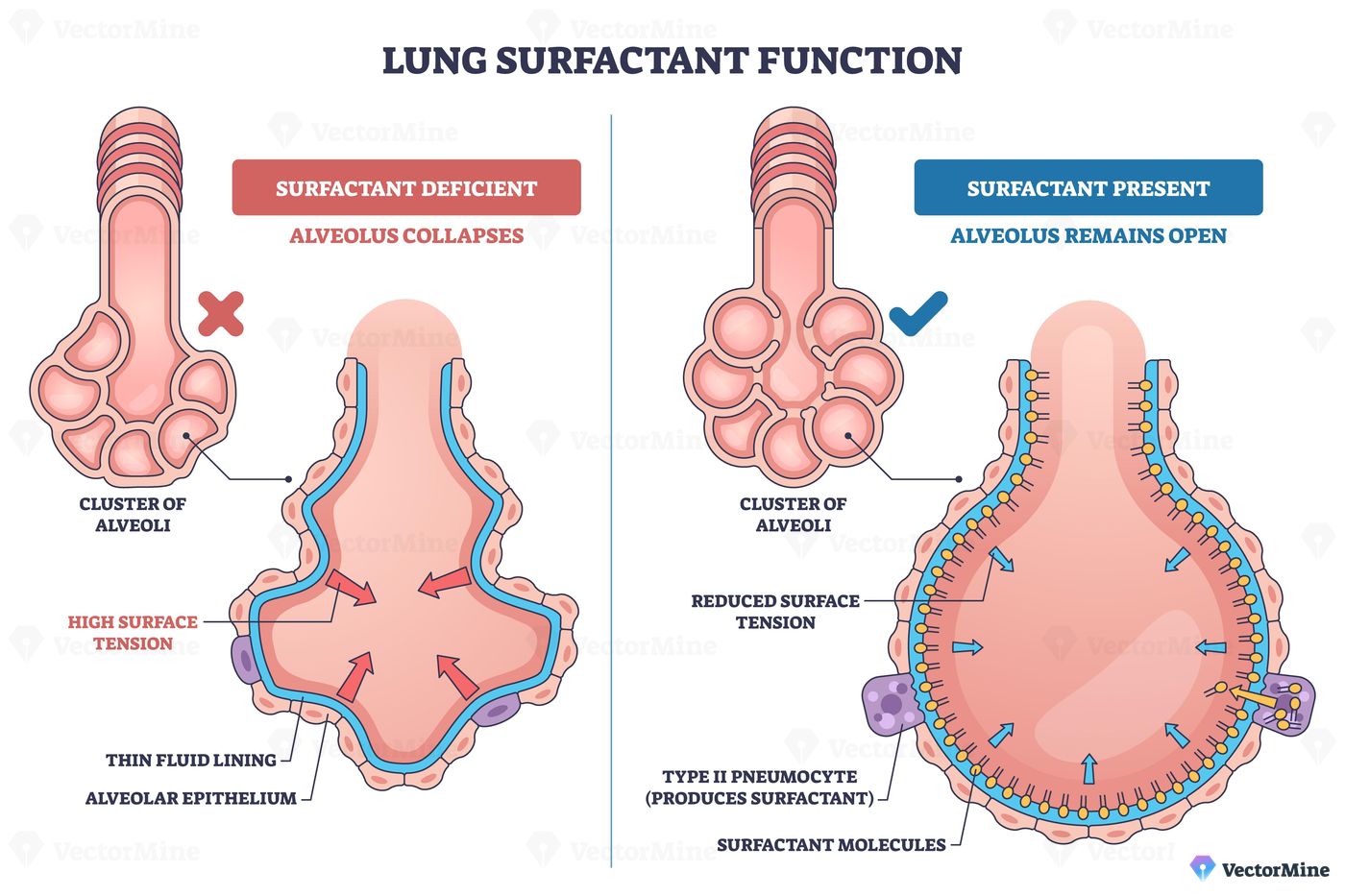 Lung surfactant function illustrated, comparison of open and collapsed alveolus, surfactant molecules and type II pneumocyte reduce surface tension to keep alveoli open. Outline diagram