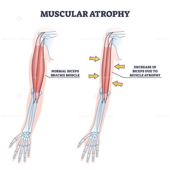 Muscular atrophy or SMA disorder example compared to healthy outline diagram