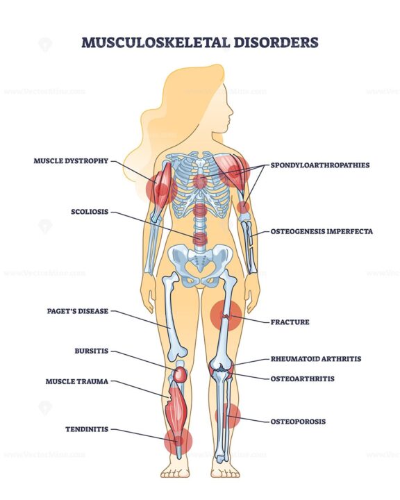 Musculoskeletal disorders diagram highlights key conditions like arthritis, osteoporosis, and scoliosis. Outline diagram.