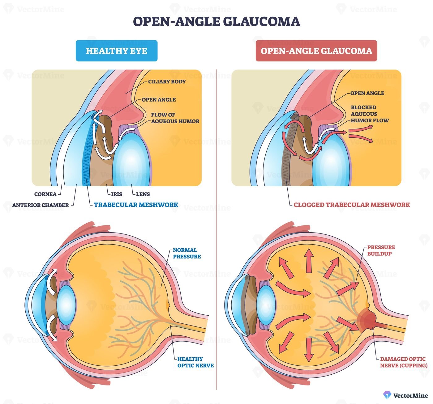 Open-angle glaucoma overview contrasts healthy vs blocked outflow, trabecular meshwork, aqueous humor flow, and optic nerve show pressure buildup concept. Outline diagram