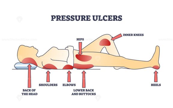 Pressure ulcers or bedsores skin tissue injuries locations outline diagram