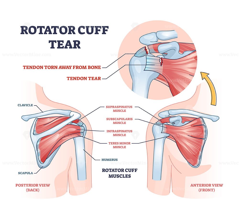 How to Do a Rotator Cuff Injury Test at Home