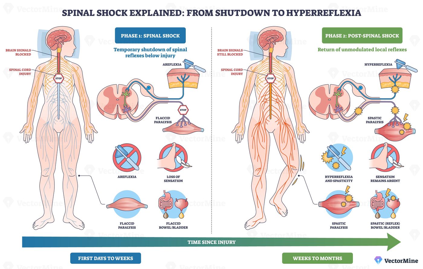 Spinal shock from shutdown to hyperreflexia shows recovery of reflexes after SCI, nervous system figure, spinal cord, and reflex hammer mark shift from areflexia to spasticity. Outline diagram