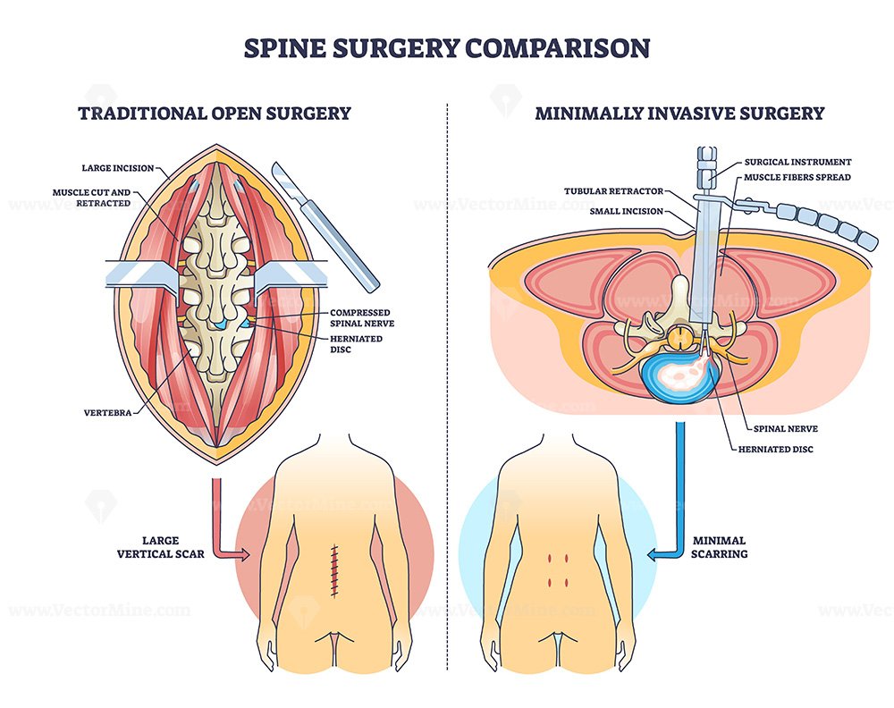 Spine surgery comparison shows open vs minimally invasive methods, highlighting vertebra, herniated disc, and spinal nerve to explain incision and scarring differences. Outline diagram