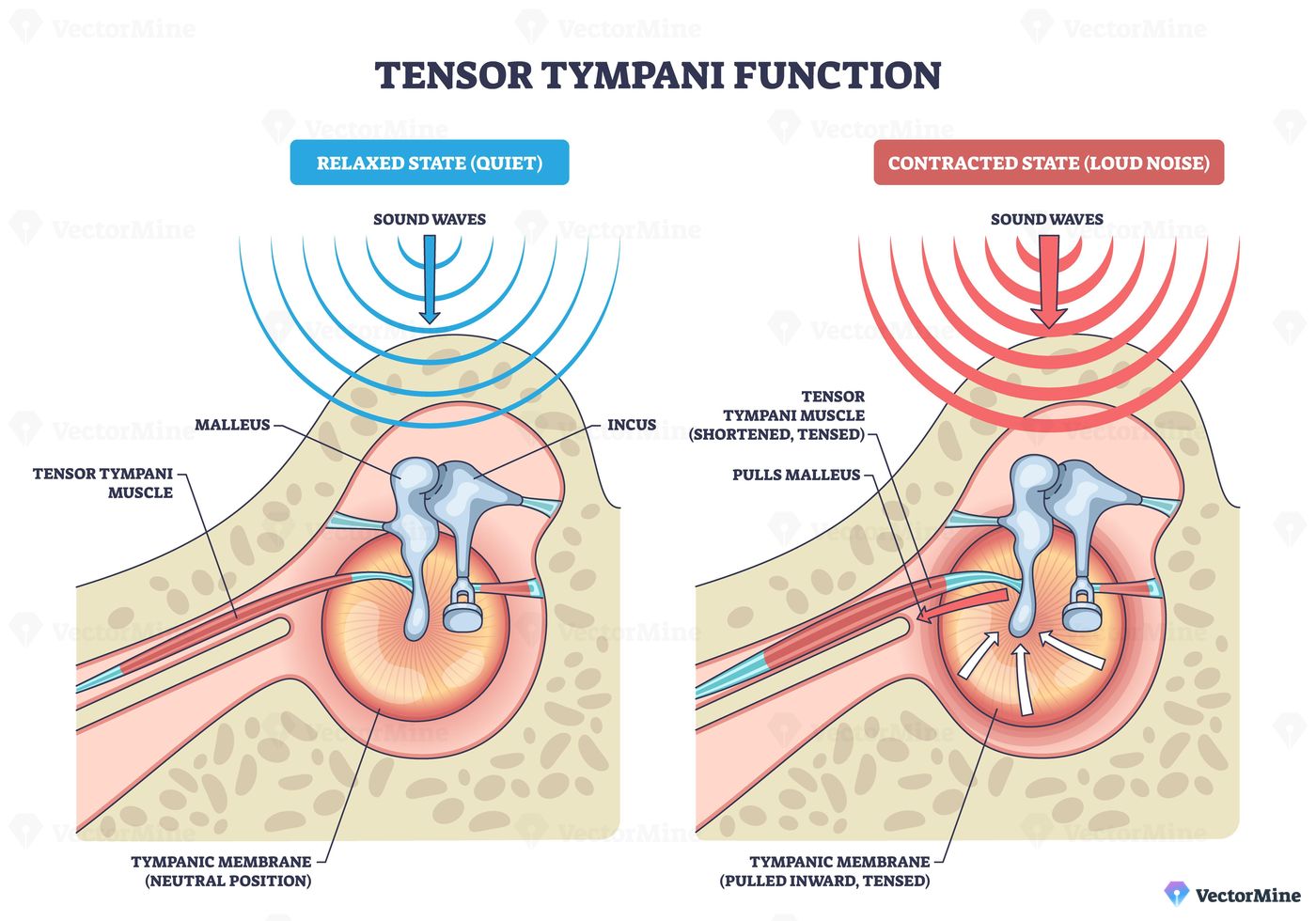 Tensor tympani function, relaxed vs contracted states show the muscle pulling the malleus to tense the tympanic membrane and protect hearing, tensor tympani, malleus, eardrum. Outline diagram