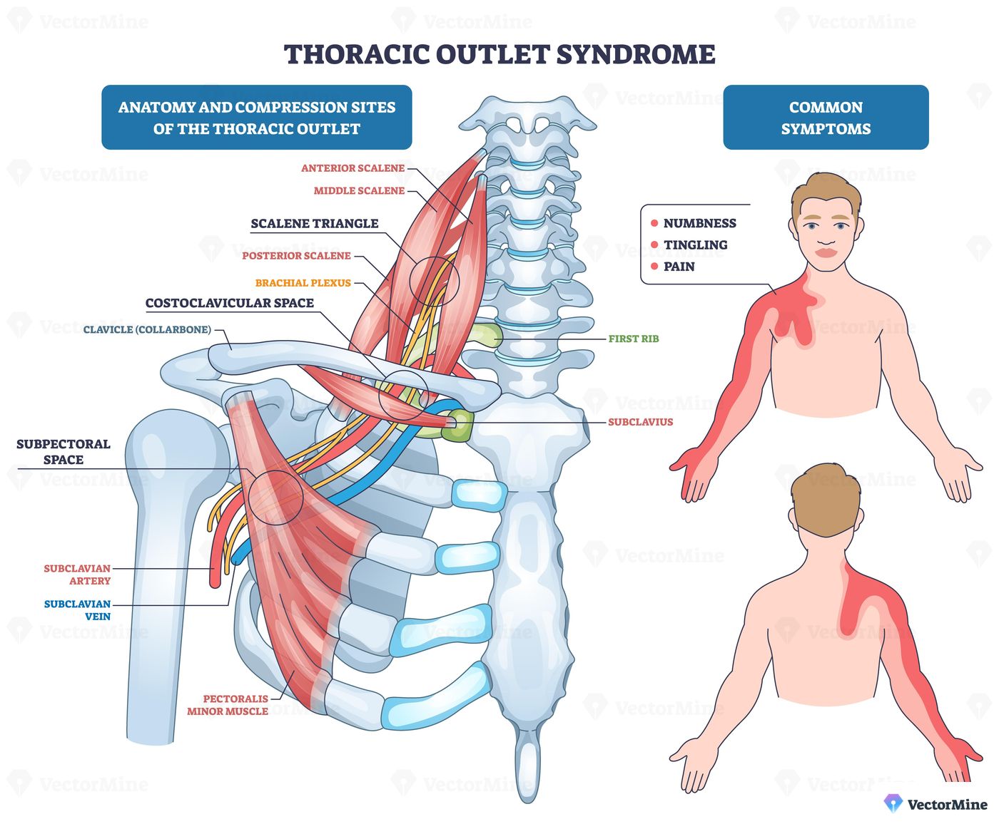 Thoracic outlet syndrome diagram shows compression of brachial plexus, subclavian artery and vein near the clavicle, mapping pain down the arm. Outline diagram