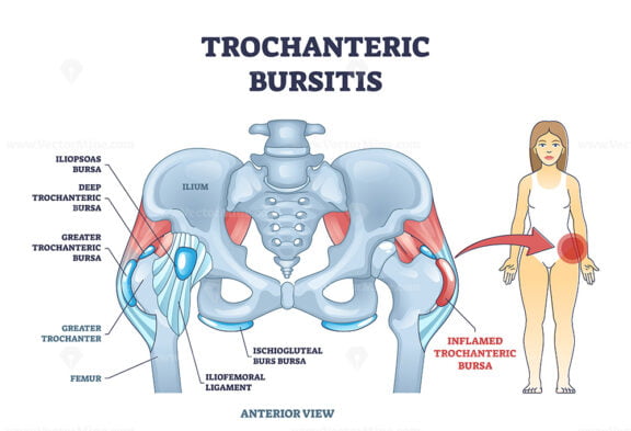 Trochanteric bursitis as bursa inflammation located in hip outline diagram