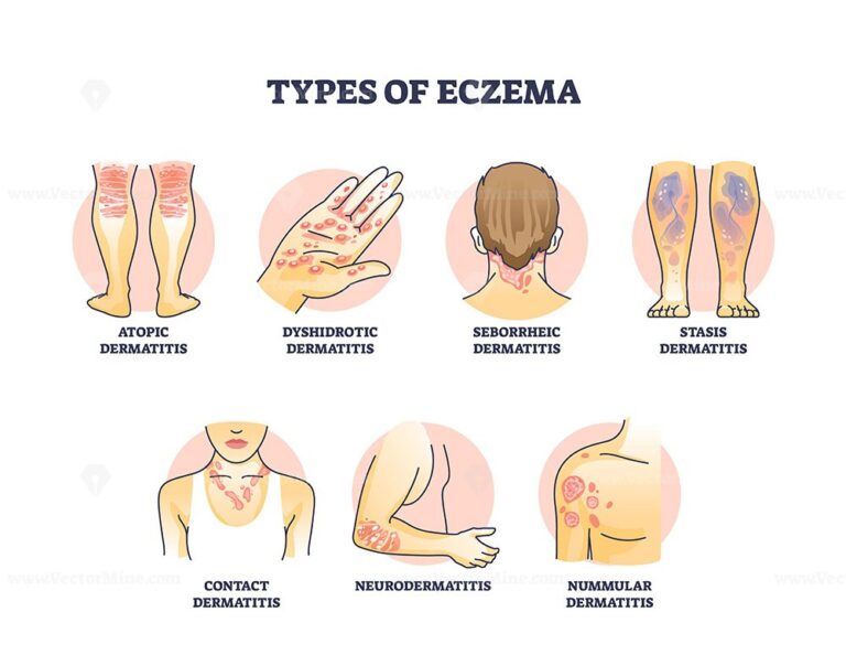 Eczema types diagram shows atopic, dyshidrotic, and seborrheic